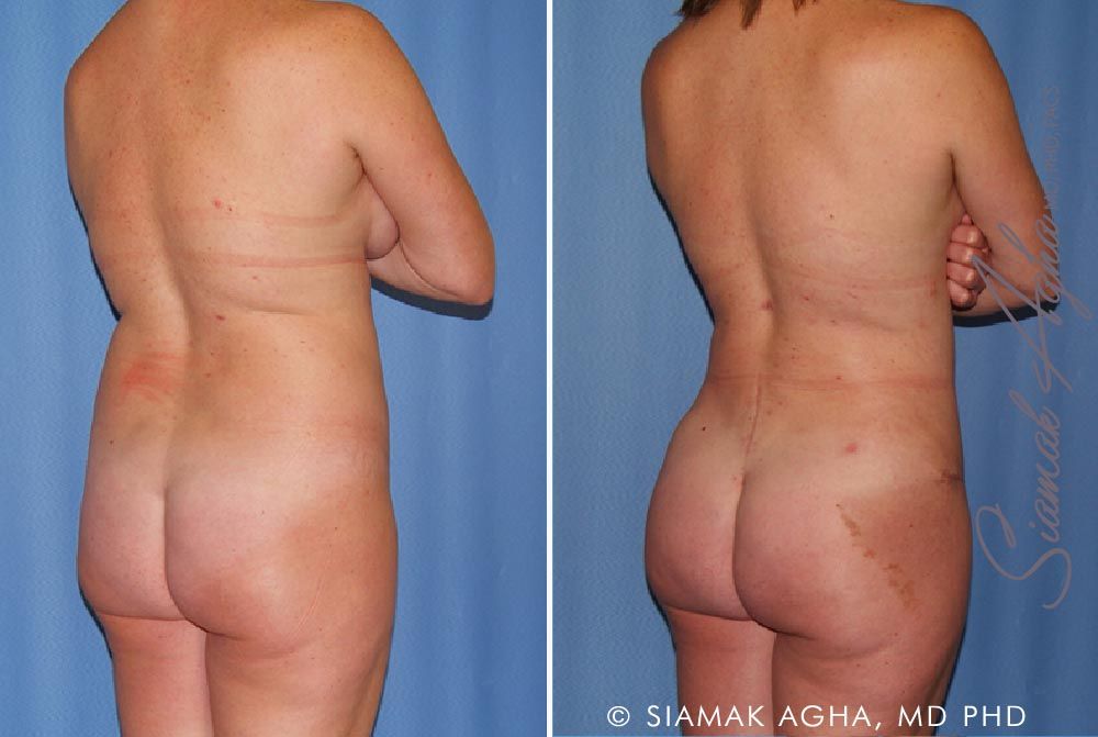 Mommy Makeover Before & After