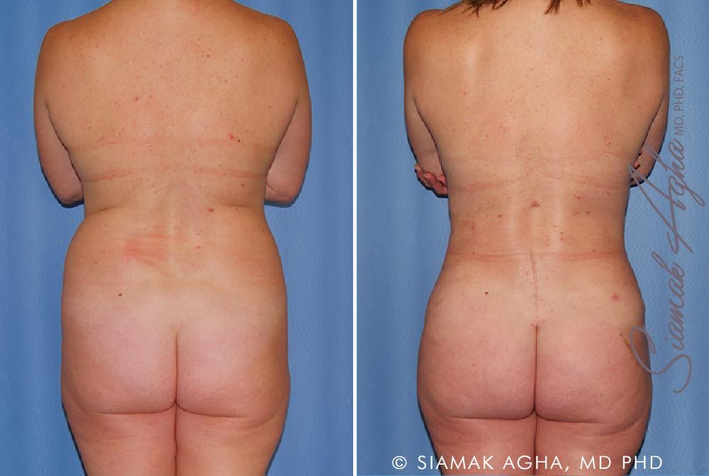 Mommy Makeover Before & After