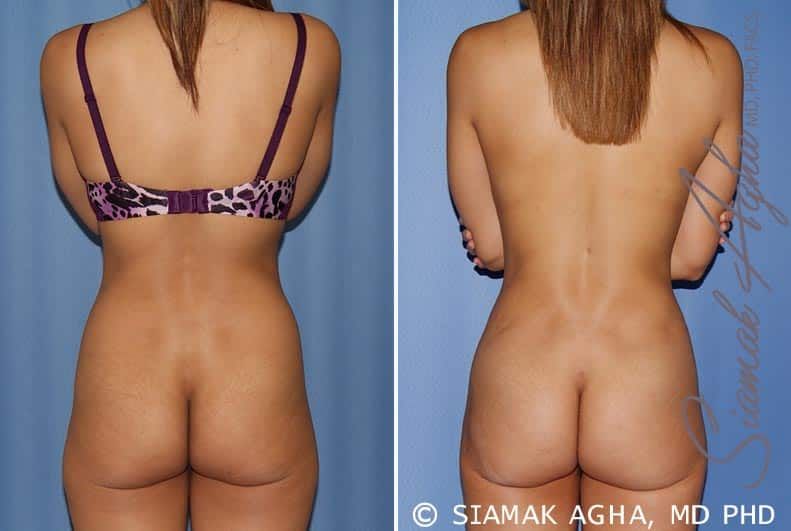 Mommy Makeover Before & After