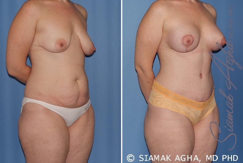 Mommy Makeover Before & After