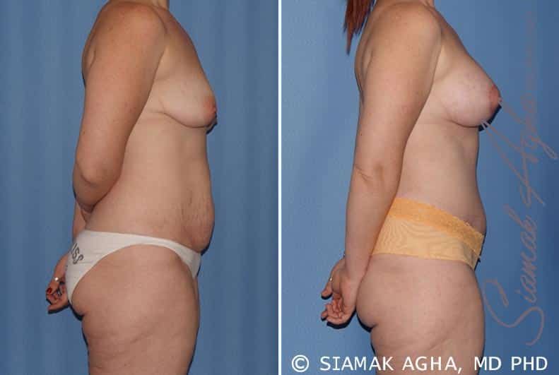 Mommy Makeover Before & After