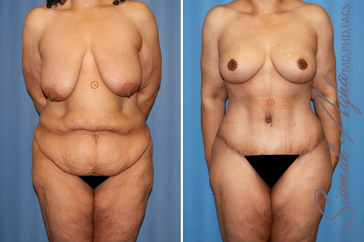 Mommy Makeover Before & After