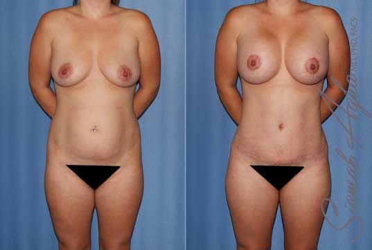 Mommy Makeover Before & After