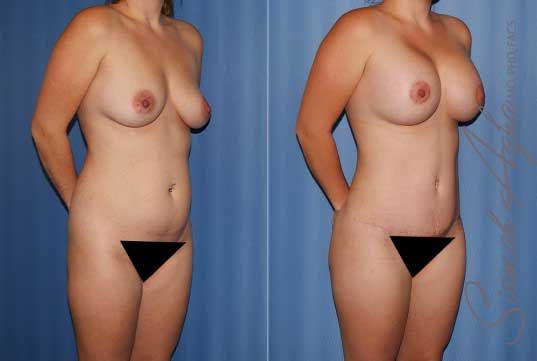 Mommy Makeover Before & After