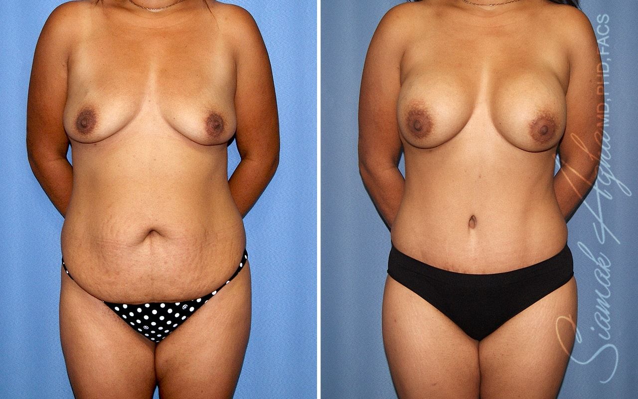 Mommy Makeover Before & After