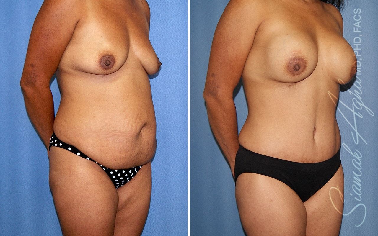 Mommy Makeover Before & After