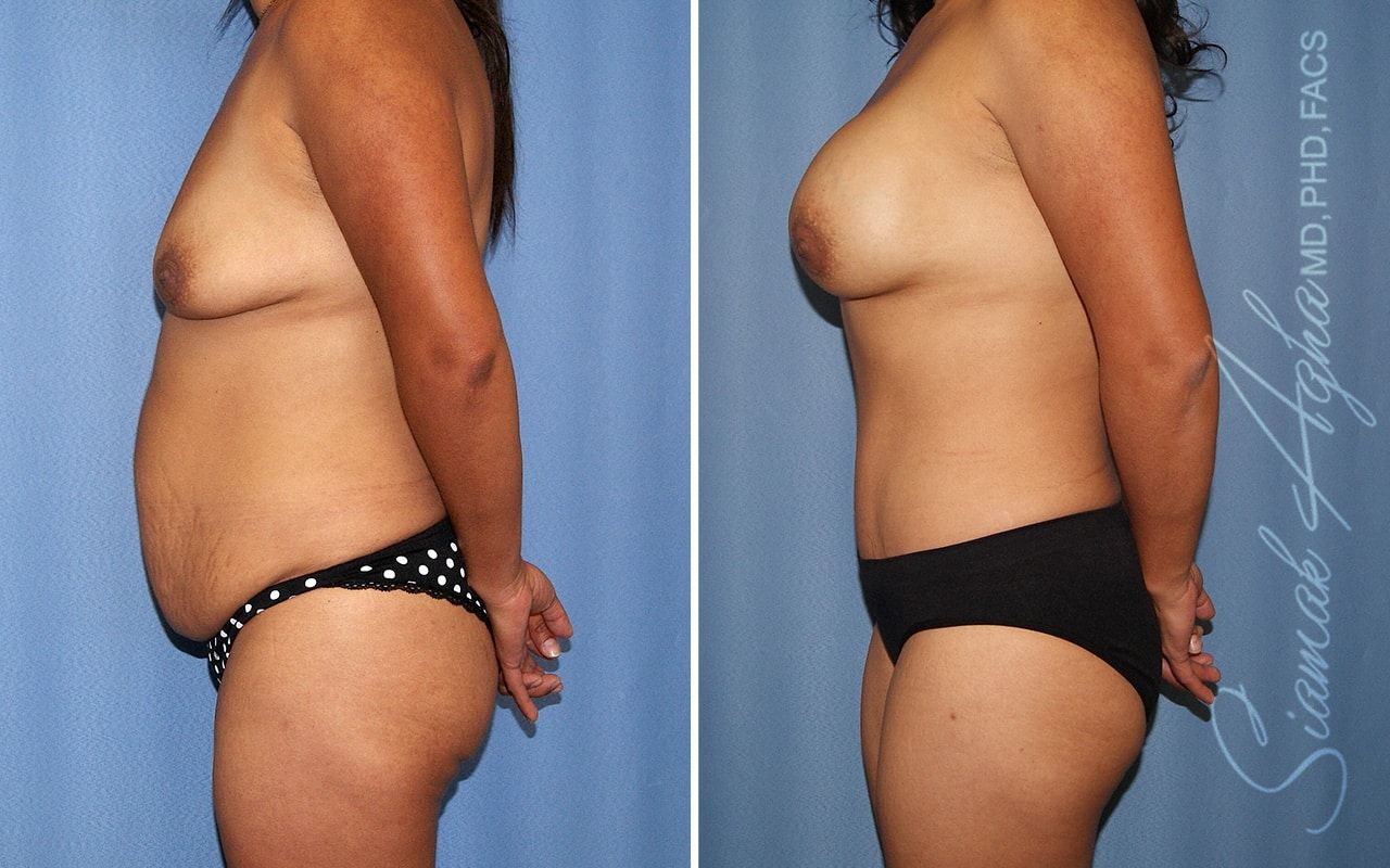 Mommy Makeover Before & After