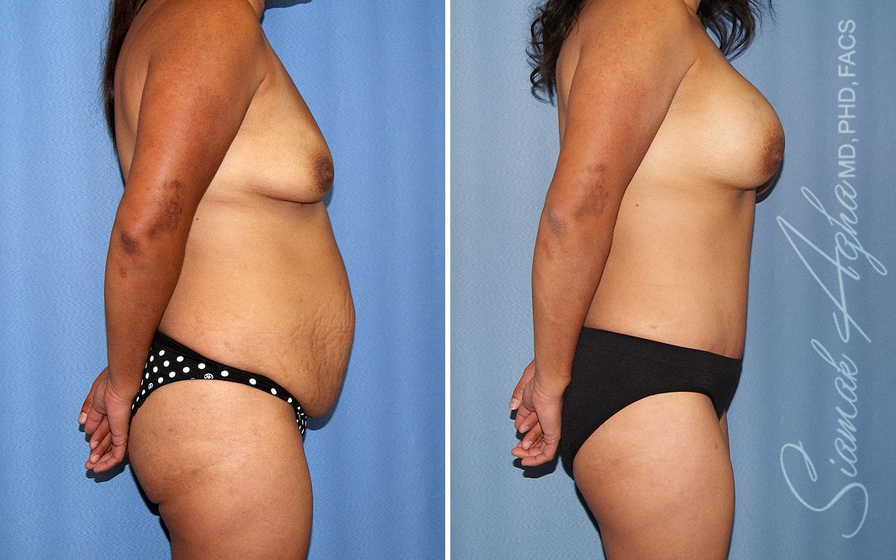 Mommy Makeover Before & After