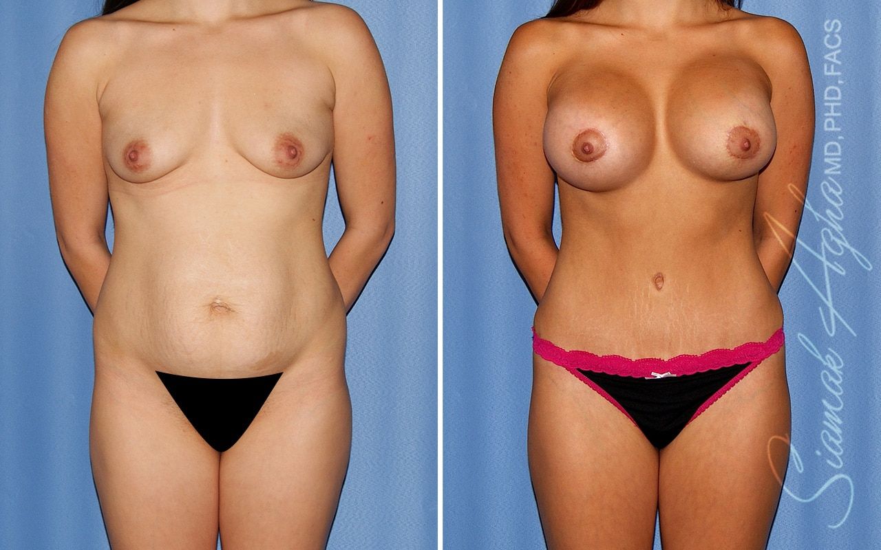 Mommy Makeover Before & After