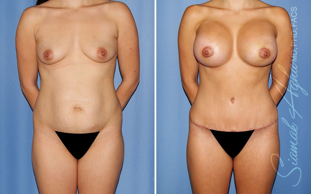 Mommy Makeover Before & After