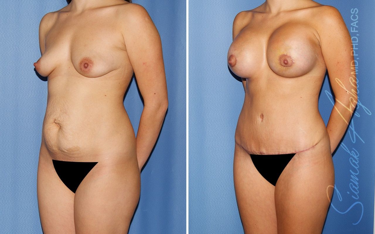 Mommy Makeover Before & After