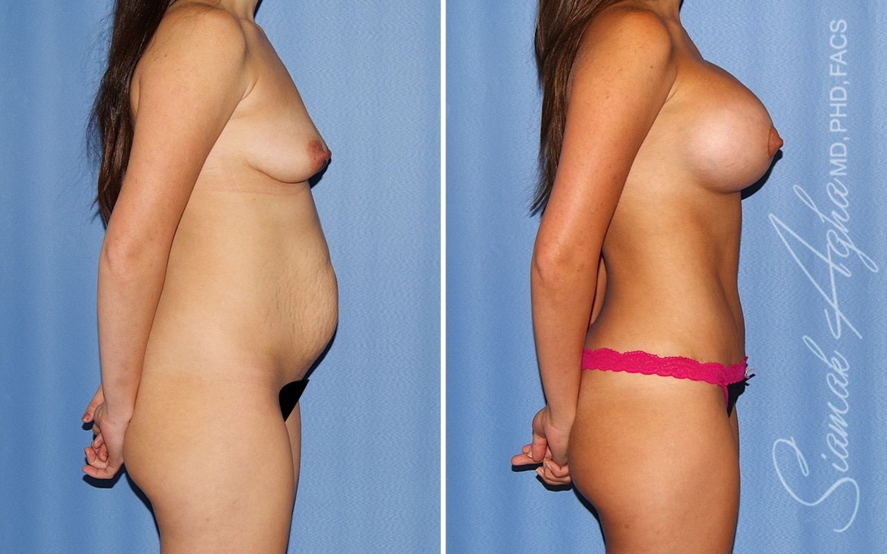 Mommy Makeover Before & After