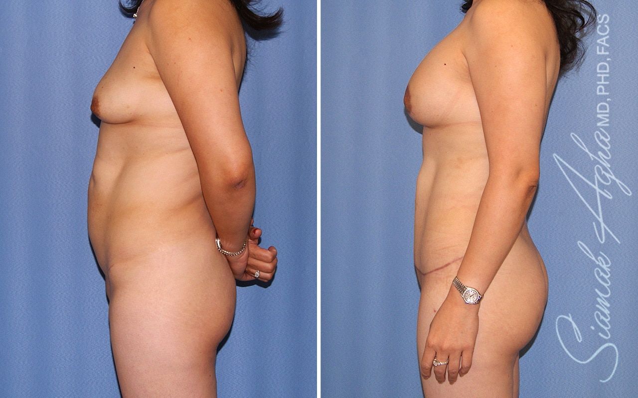 Mommy Makeover Before & After