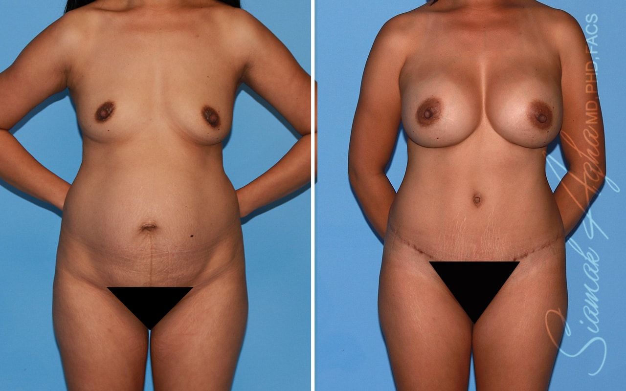 Mommy Makeover Before & After