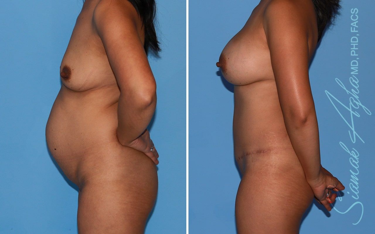 Mommy Makeover Before & After