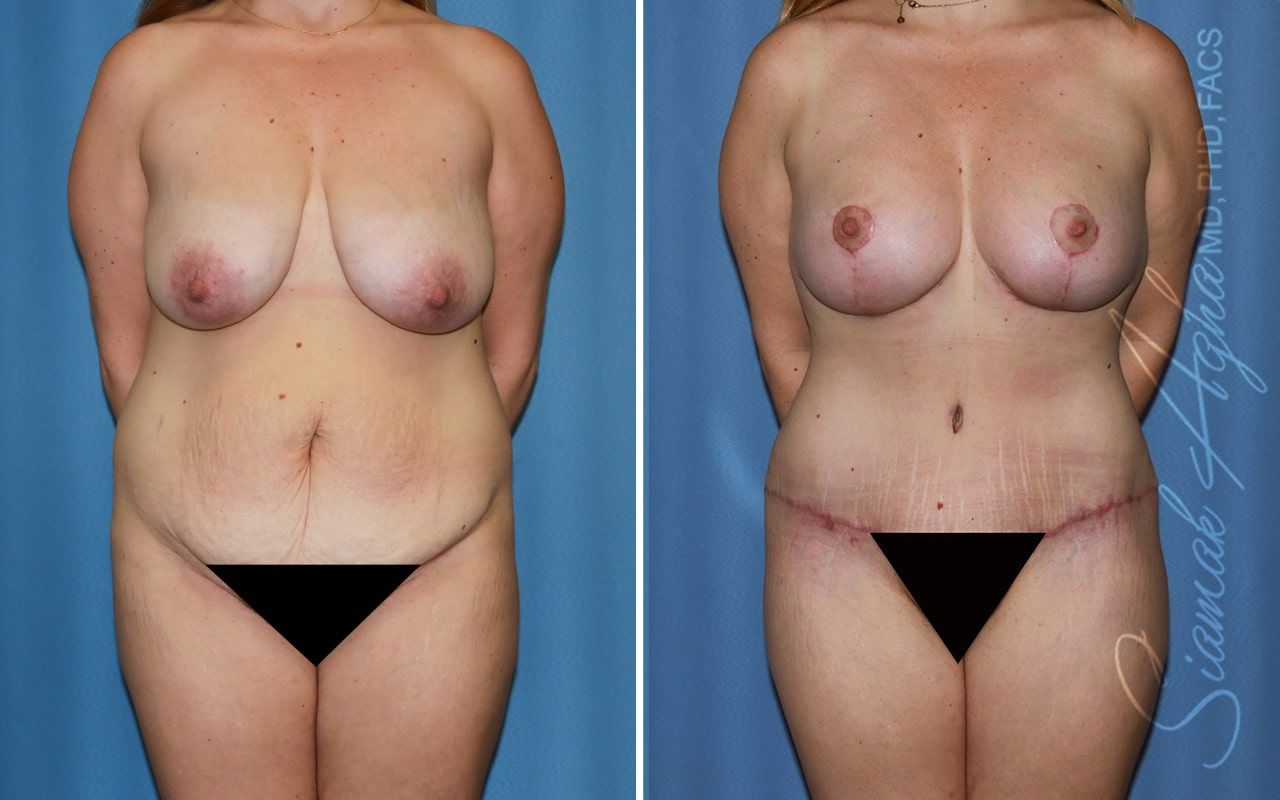 Mommy Makeover Before & After