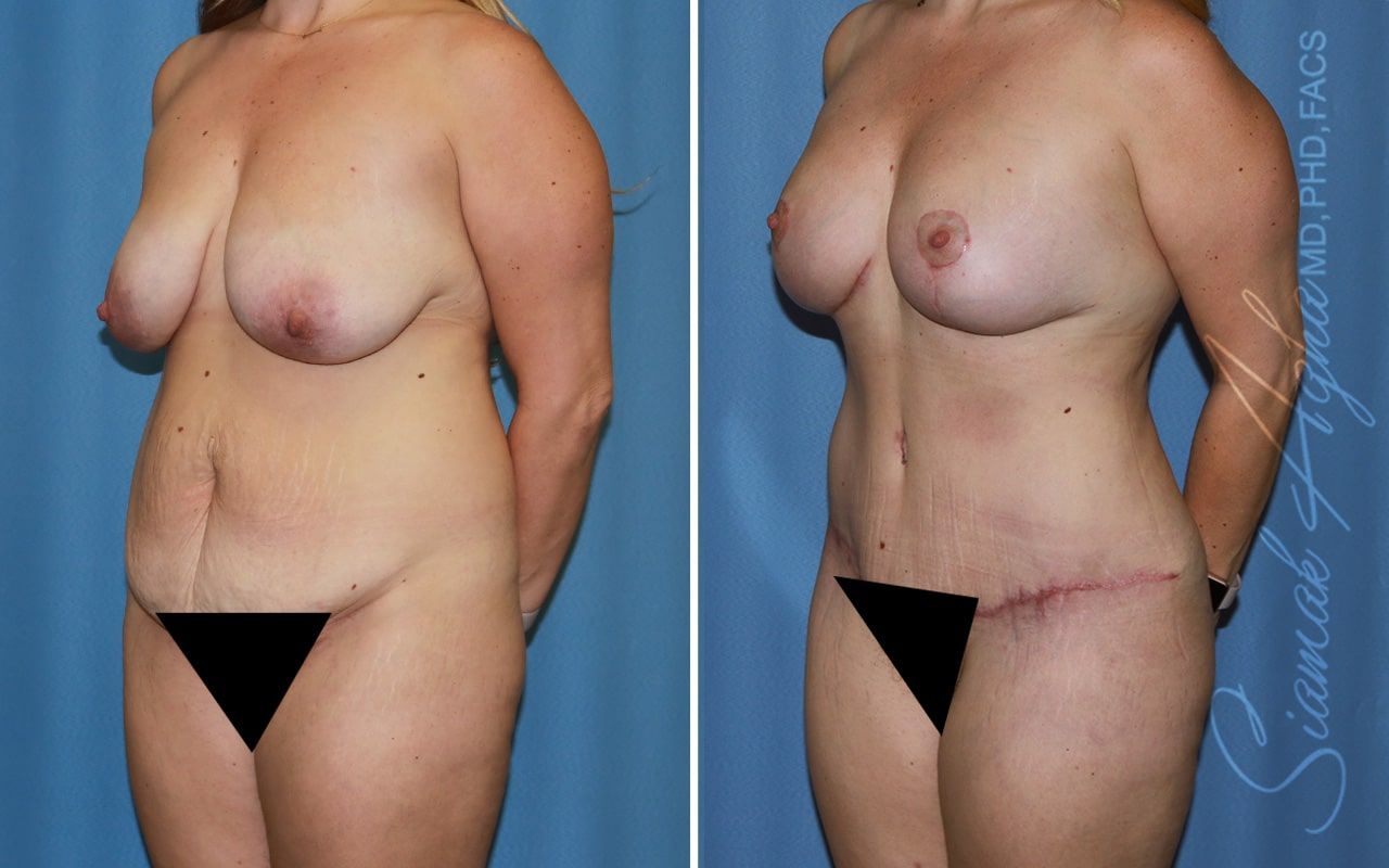 Mommy Makeover Before & After