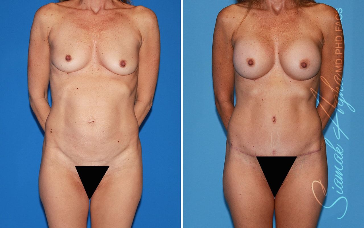 Mommy Makeover Before & After