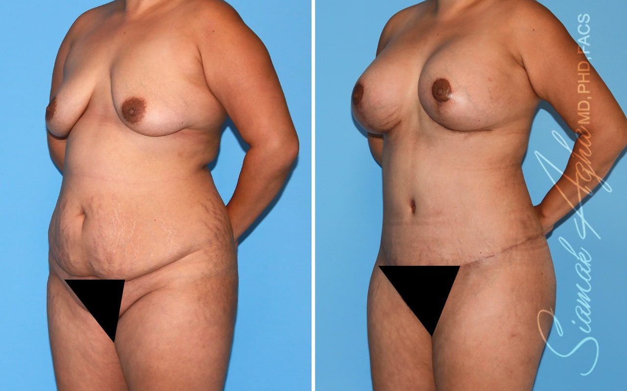 Mommy Makeover Before & After