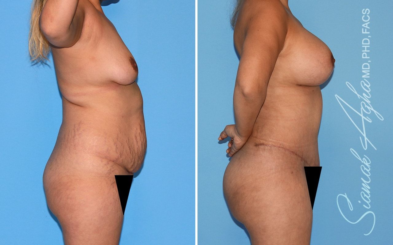 Mommy Makeover Before & After