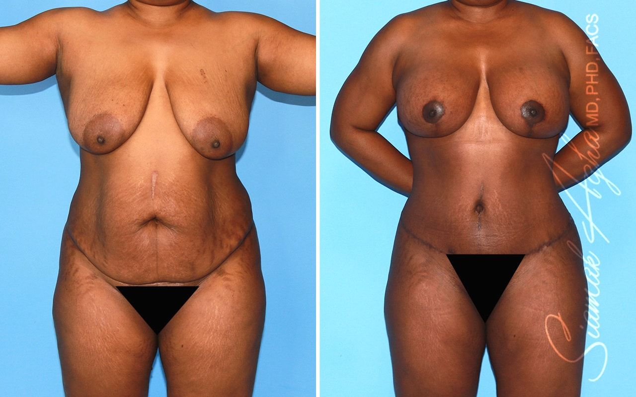 Mommy Makeover Before & After