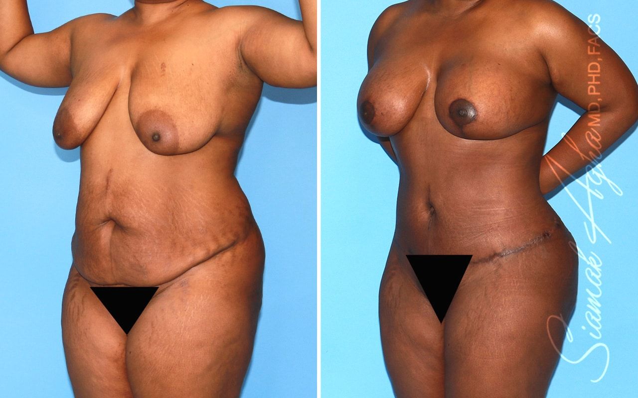 Mommy Makeover Before & After