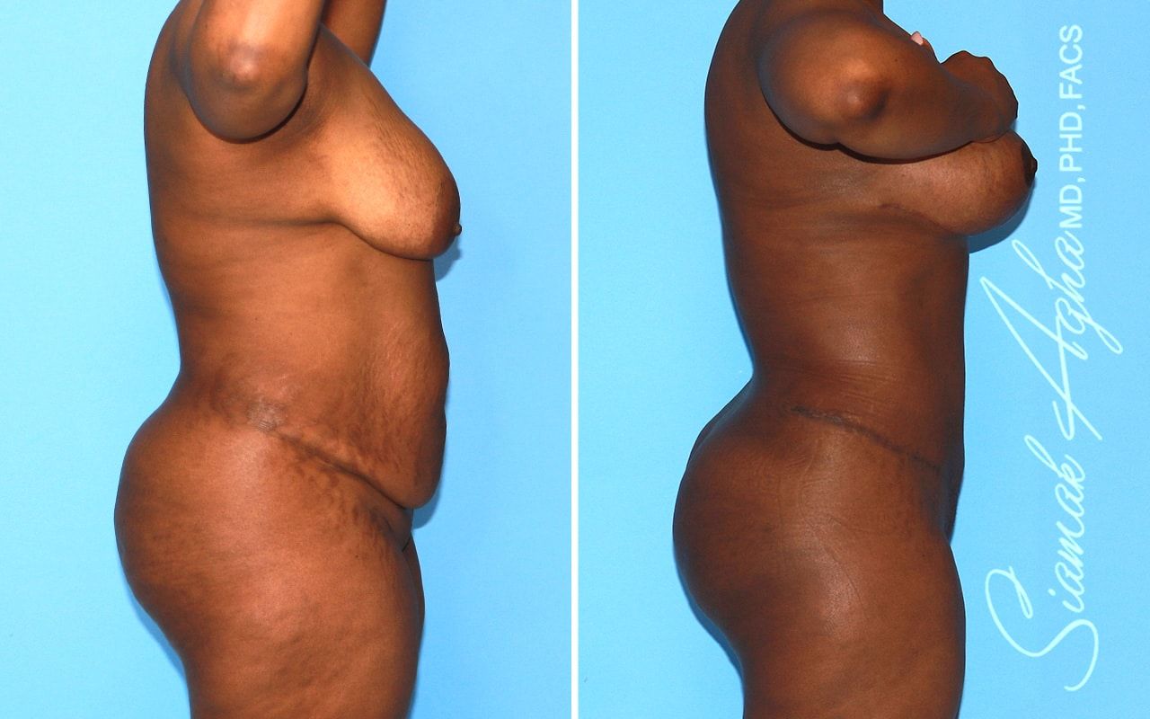 Mommy Makeover Before & After