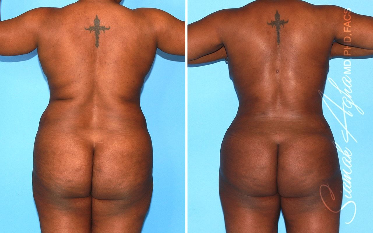 Mommy Makeover Before & After