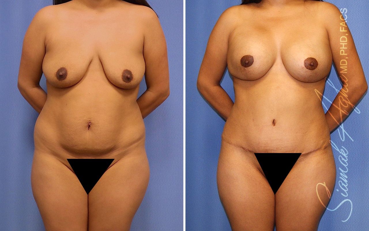 Mommy Makeover Before & After