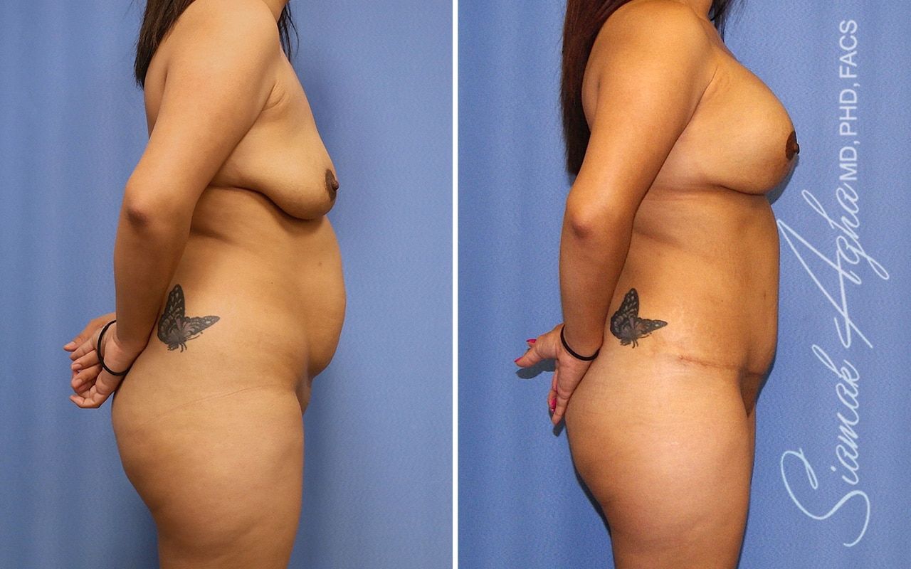 Mommy Makeover Before & After