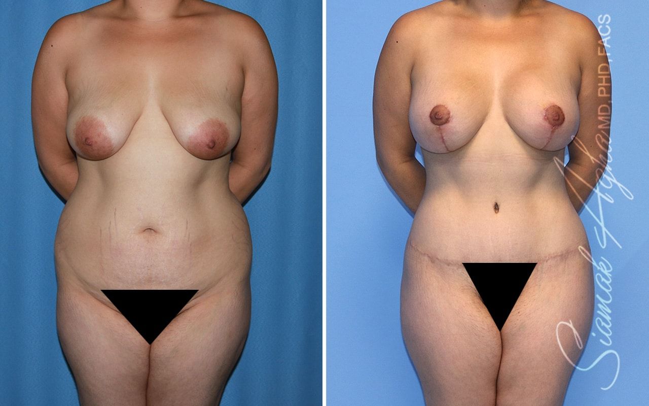 Mommy Makeover Before & After