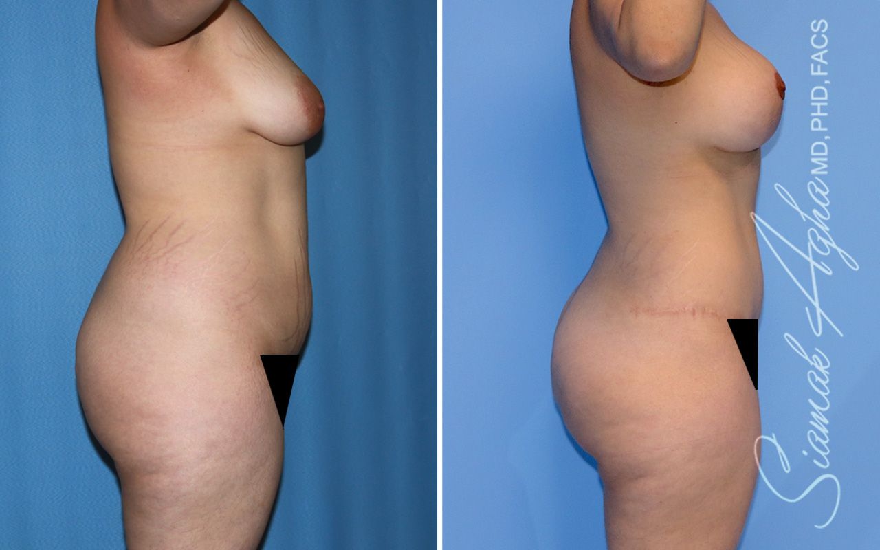 Mommy Makeover Before & After