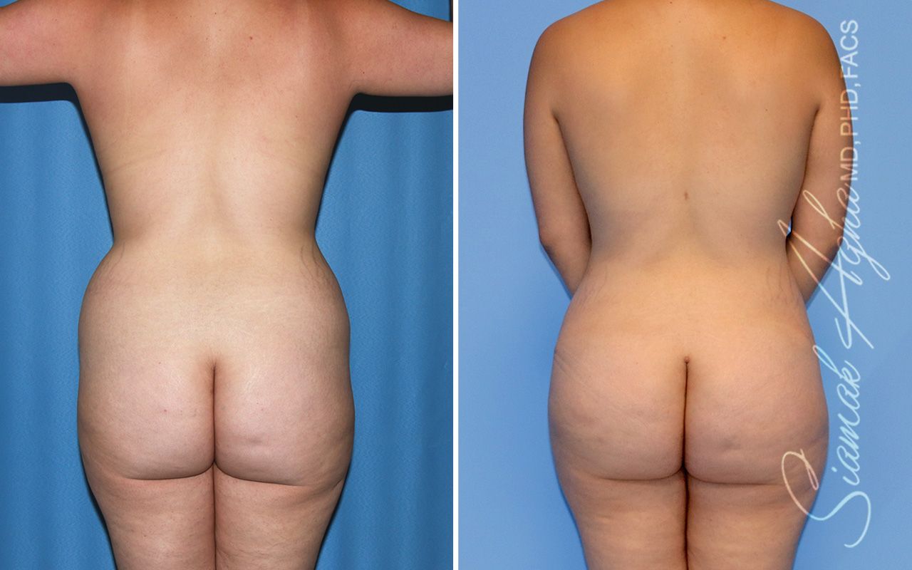 Mommy Makeover Before & After