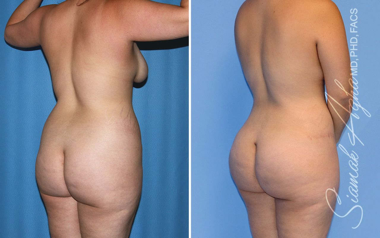 Mommy Makeover Before & After