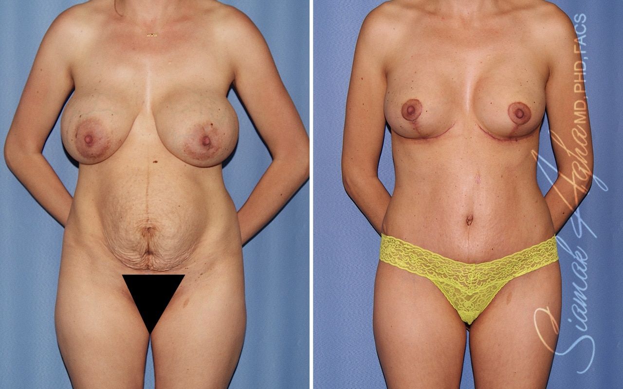 Mommy Makeover Before & After