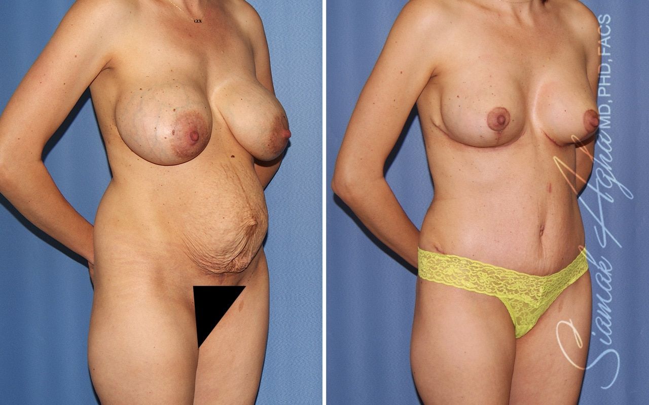 Mommy Makeover Before & After