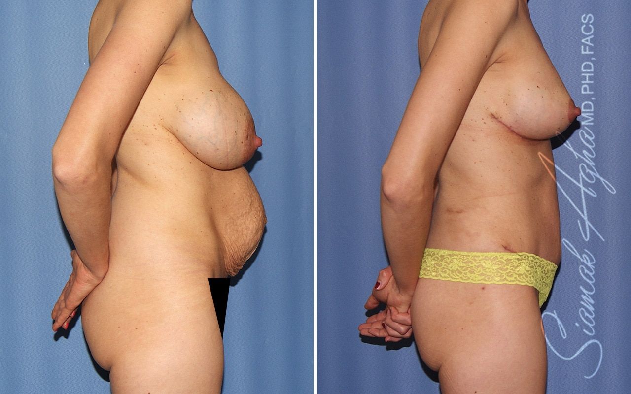 Mommy Makeover Before & After