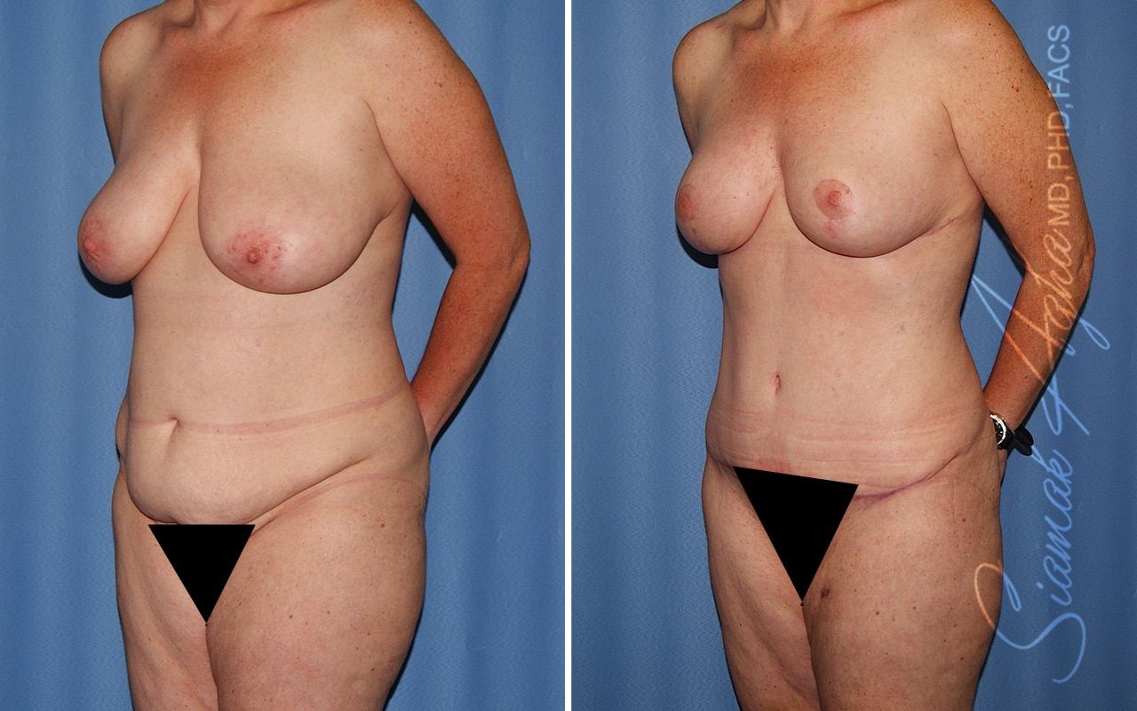 Mommy Makeover Before & After