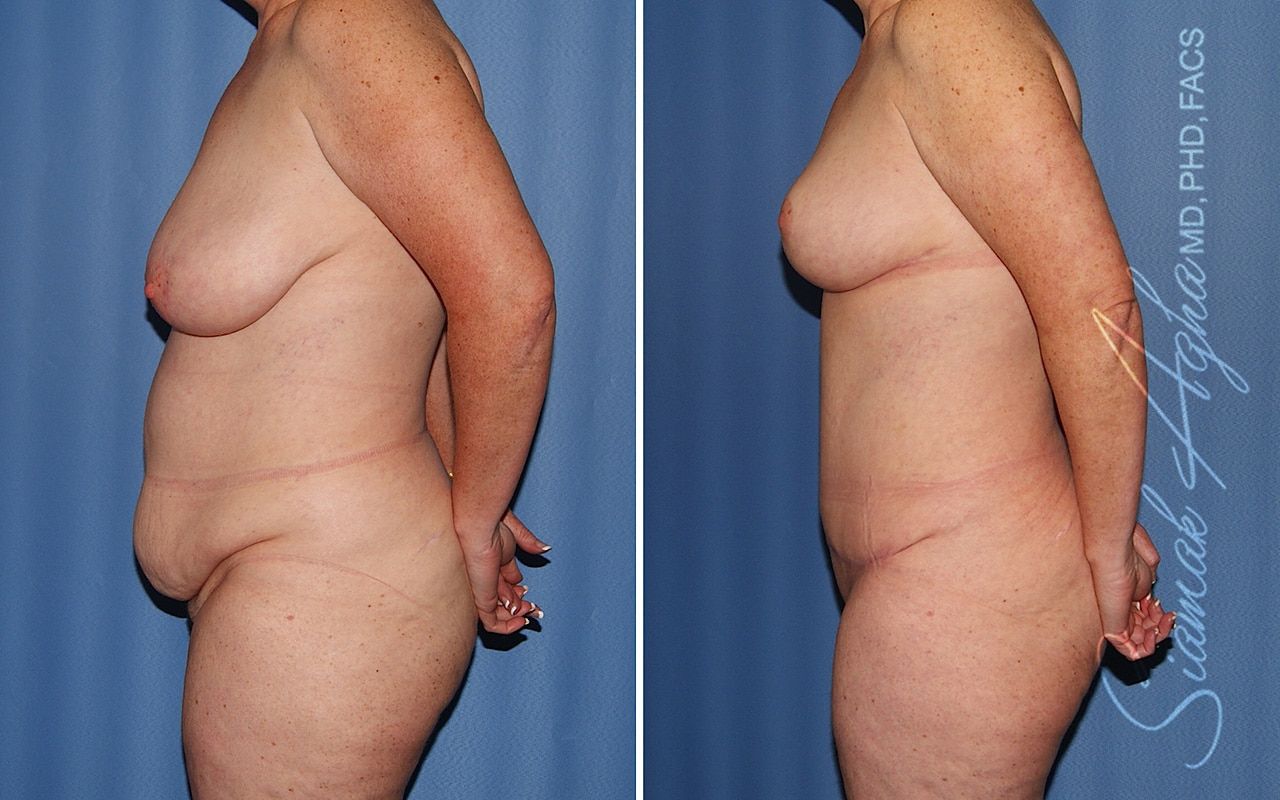 Mommy Makeover Before & After