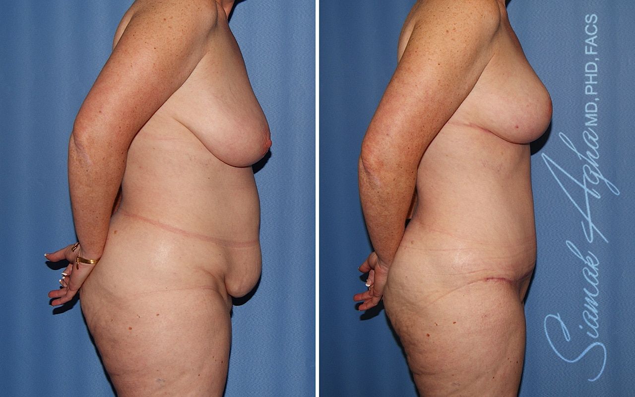 Mommy Makeover Before & After