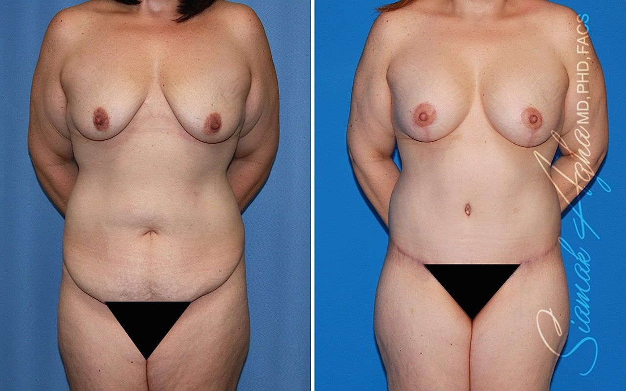 Mommy Makeover Before & After