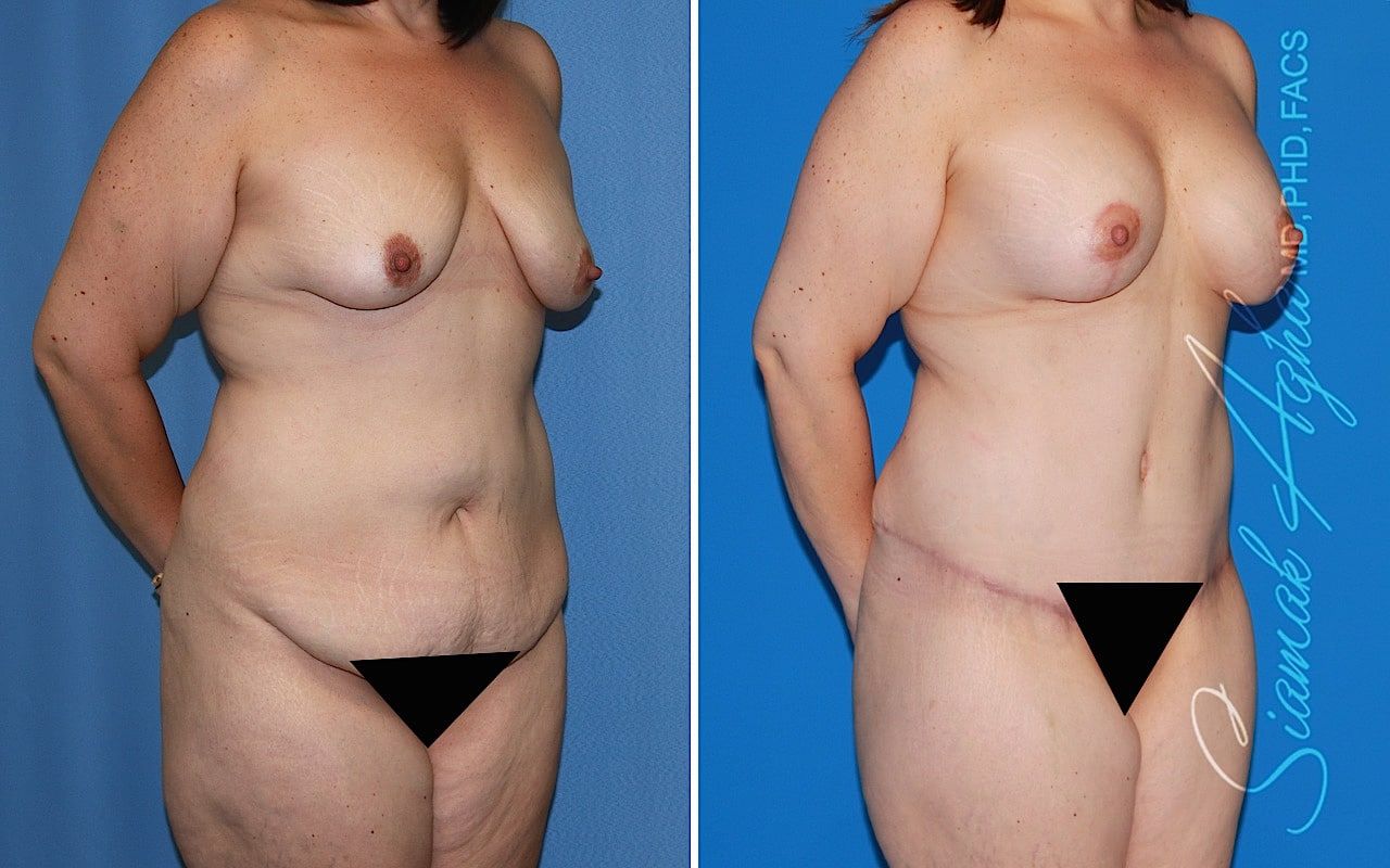 Mommy Makeover Before & After