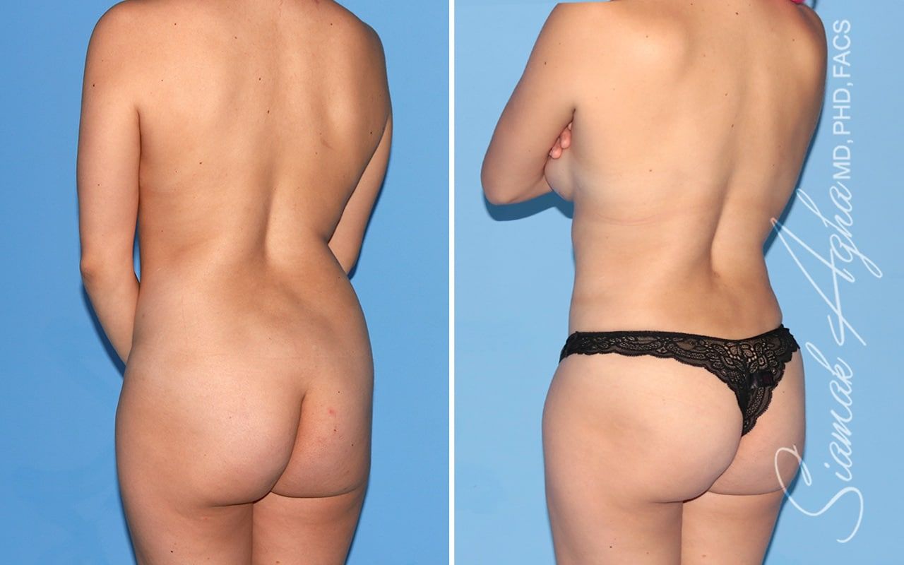 Mommy Makeover Before & After