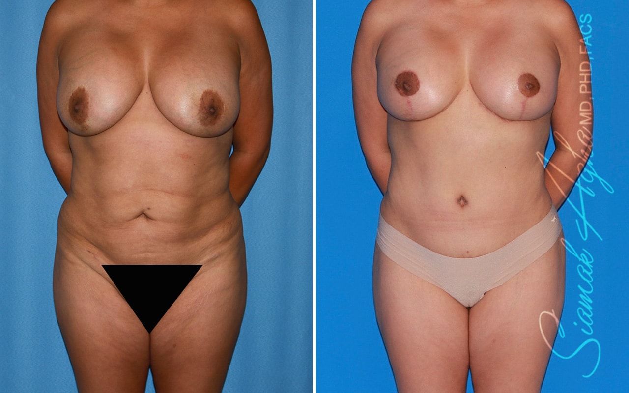 Mommy Makeover Before & After