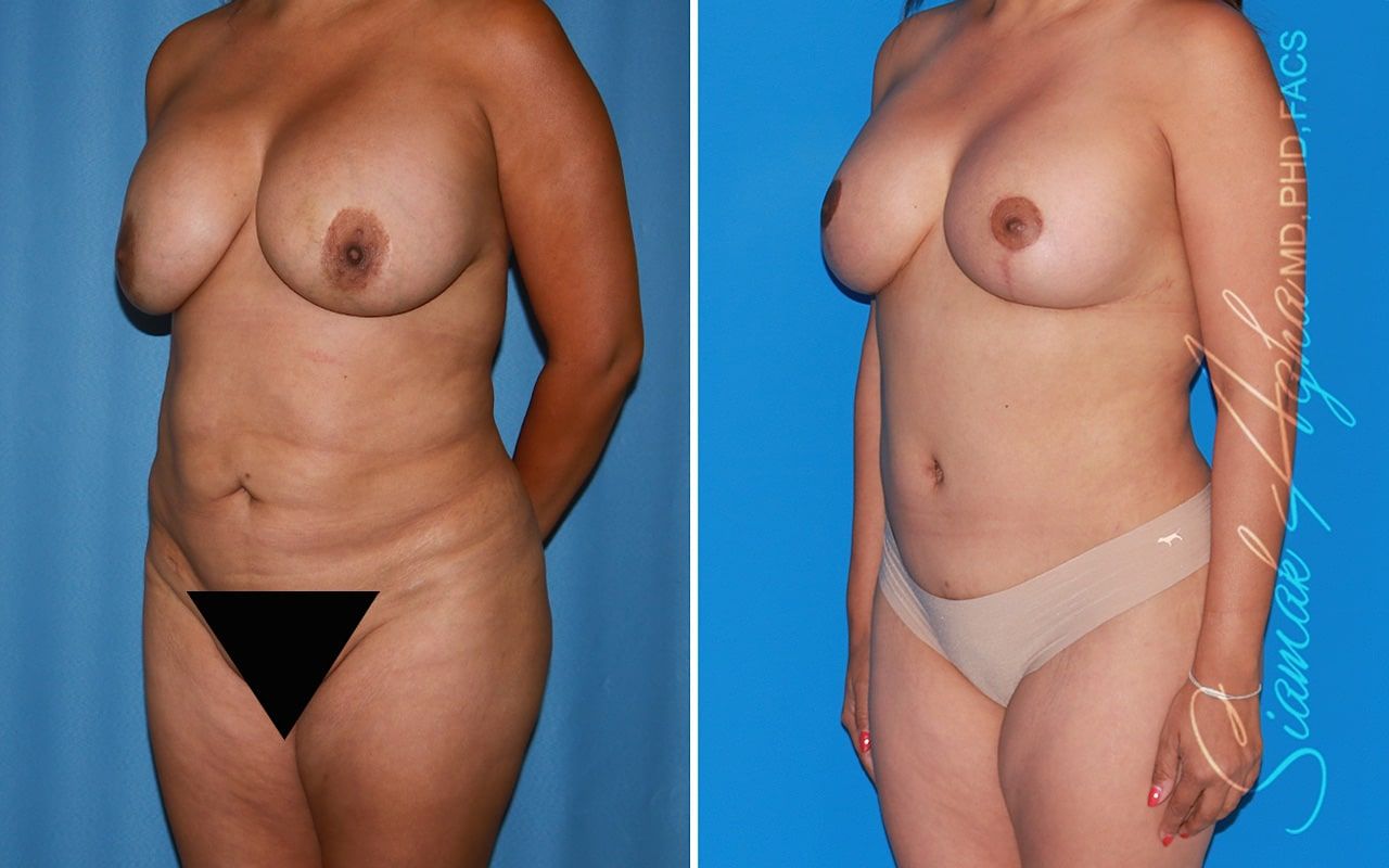 Mommy Makeover Before & After