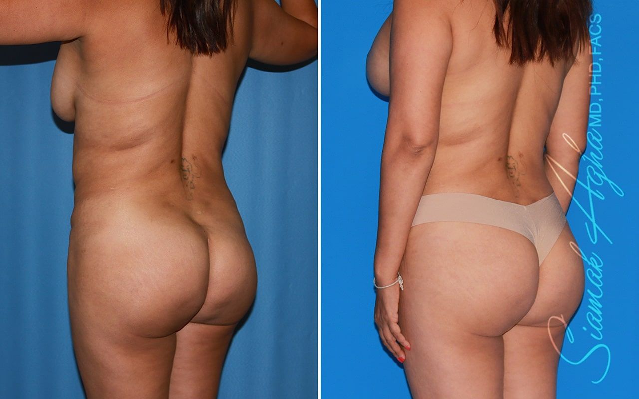 Mommy Makeover Before & After