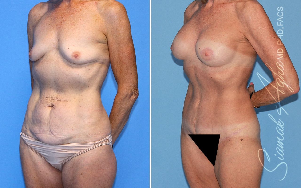 Mommy Makeover Before & After