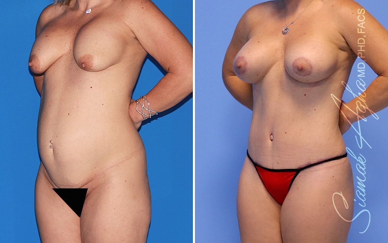 Mommy Makeover Before & After