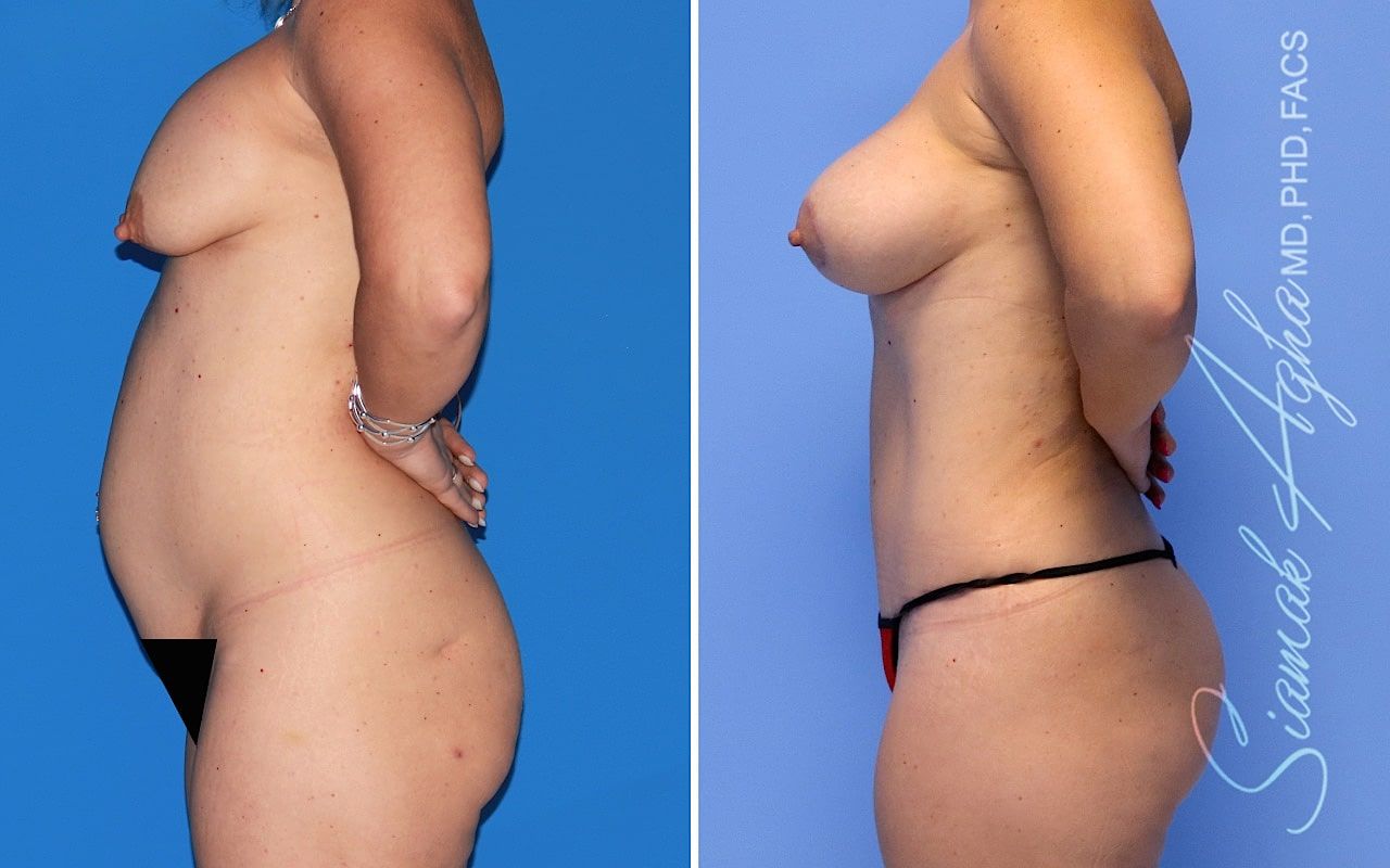 Mommy Makeover Before & After