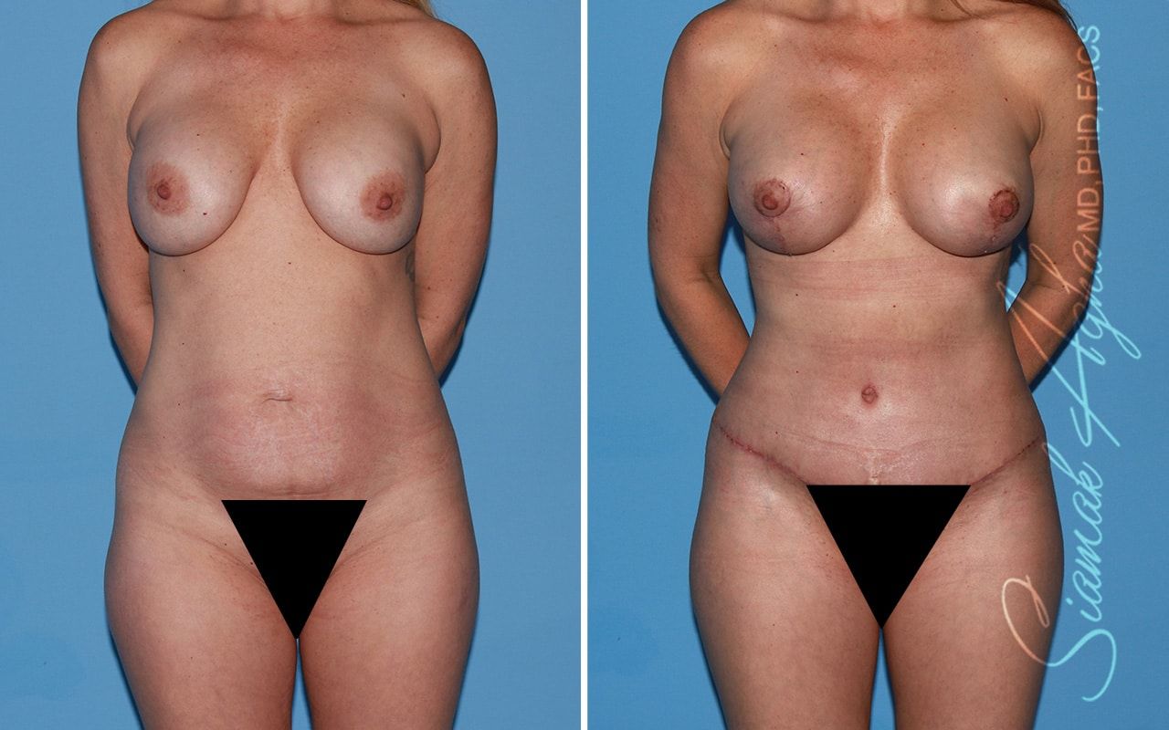 Mommy Makeover Before & After